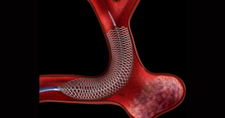 Hospital das Clínicas de Ribeirão Preto inicia uso pioneiro de novo dispositivo para tratamento de aneurismas cerebrais