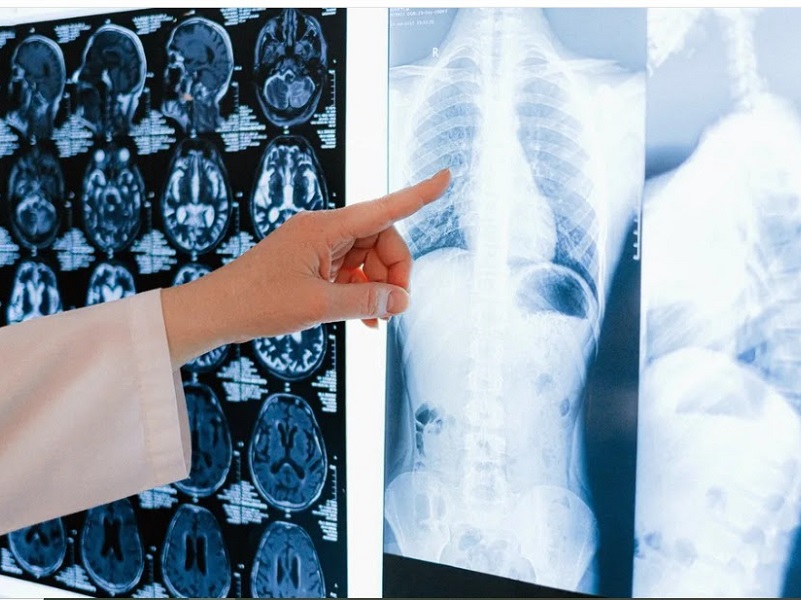 Oncoclínicas e Casa de Saúde São José lançam programa de cuidados para nódulos pulmonares